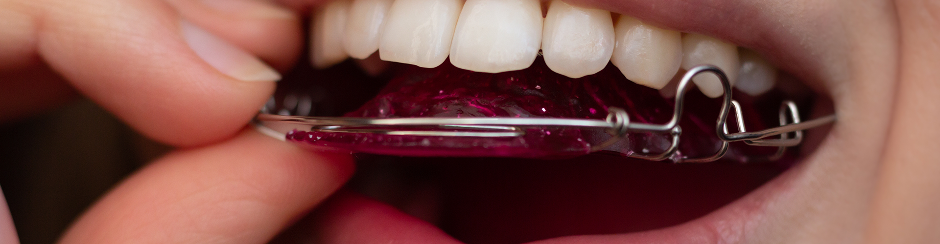Woman placing retainer in mouth.